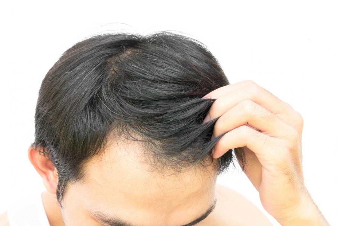 hair transplant costs in Pune